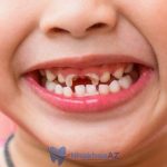 Bé bị sún răng phải làm sao