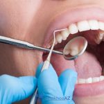 Bị ê răng sau khi lấy cao răng