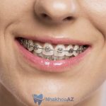 các loại niềng răng hiện nay