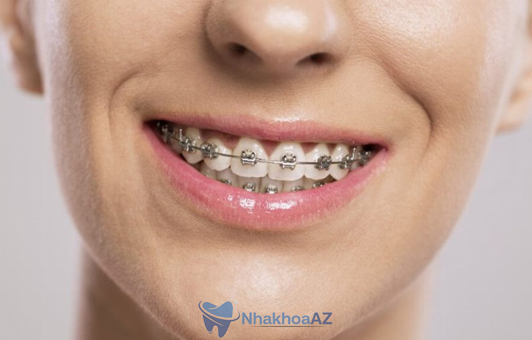 Niềng răng bằng mắc cài kim loại phù hợp với những người có hàm xanh xô lệch, hô hay móm,...