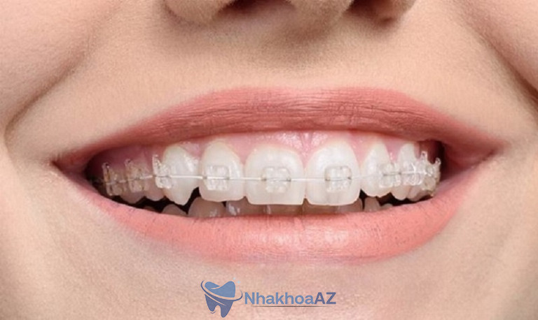 Mắc cài sứ có màu trong suốt nên người ngoài khó nhận ra bạn đang niềng răng