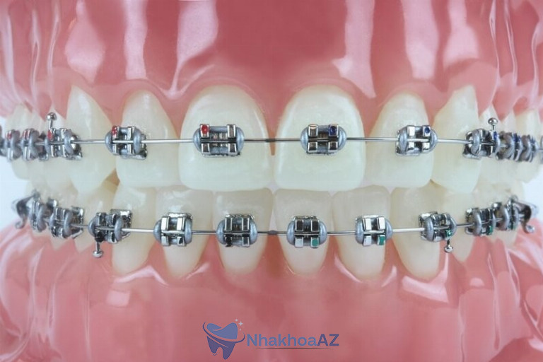 Niềng răng mắc cài tự đóng mang nhiều ưu điểm vượt trội