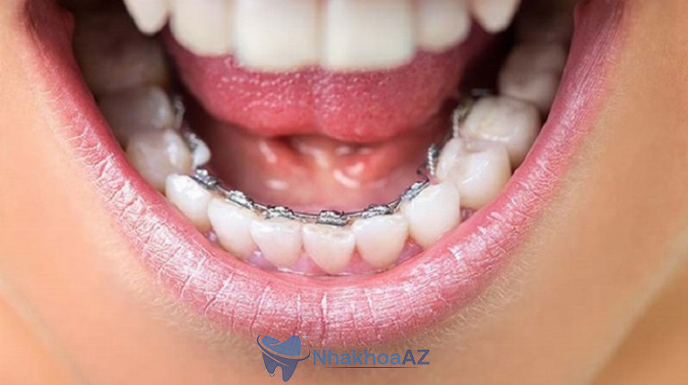 Mắc cài mặt lưỡi còn được gọi là mắc cài trong