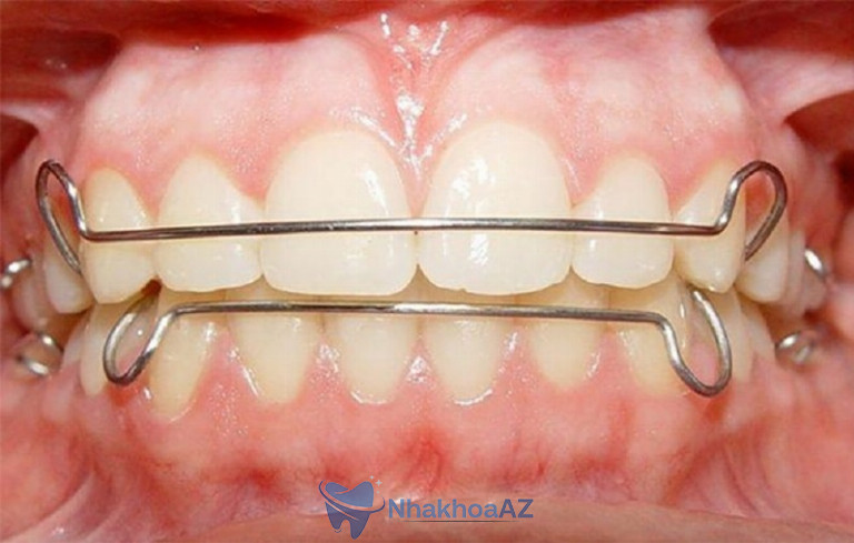 Niềng răng bằng khí cụ kim loại được khá ít người lựa chọn