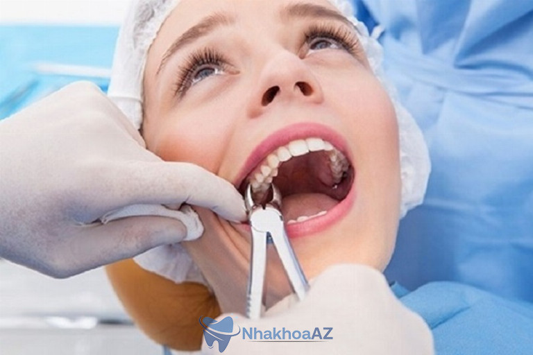 Nhổ răng được chỉ định với trường hợp bệnh nhân bị áp xe rặng
