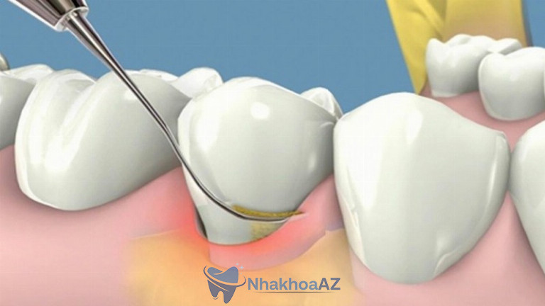 Lấy vôi răng đúng cách sẽ không gây đau đơn, khó chịu