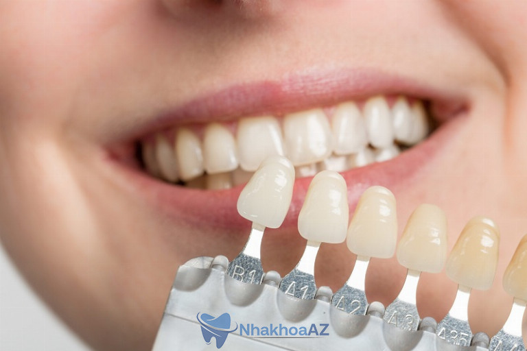 Dán Veneer là công nghệ thẩm mỹ nha khoa được nhiều người tin tưởng hiện nay