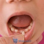 Nhổ răng sữa cho bé