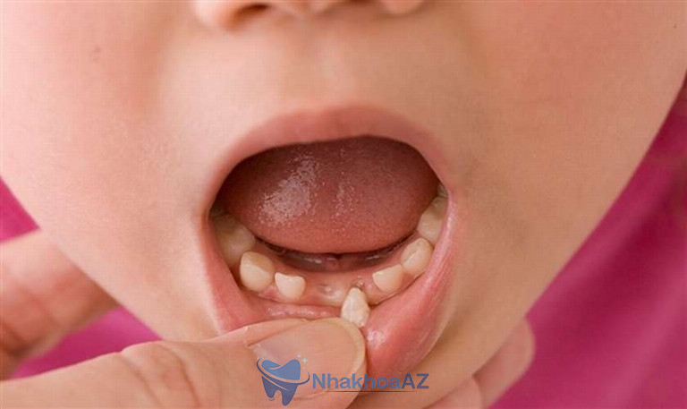 Nhổ răng sữa cho bé vào thời điểm thay răng