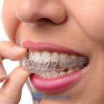 nieng rang invisalign