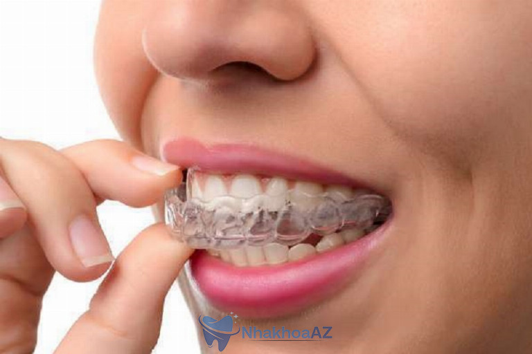 Niềng Invisalign chính là niềng răng trong suốt