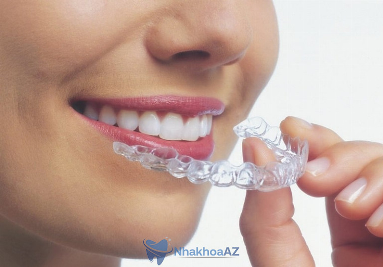 Niềng răng trong suốt là phương pháp hiện đại, được khá nhiều người áp dụng