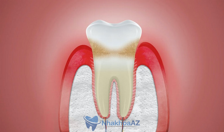 Nướu răng là gì? Là các mô mềm bao quanh chân răng
