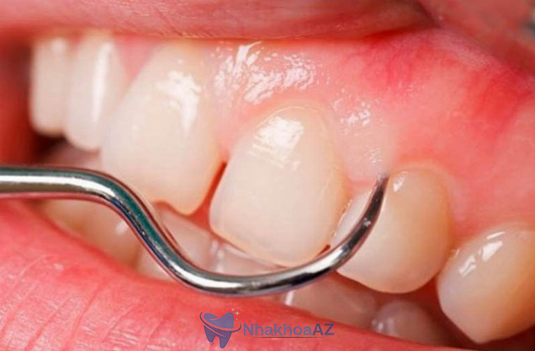 Nướu rời là phần nướu tách ra được khỏi chân răng