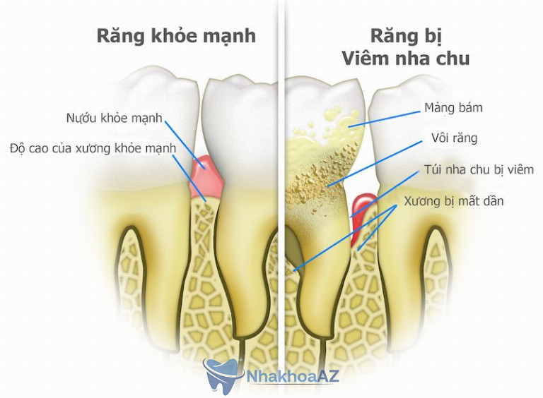 Hình ảnh nướu răng khỏe mạnh và khi bị viêm nha chu