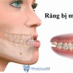 răng bị móm nên đi niềng chỉnh nha