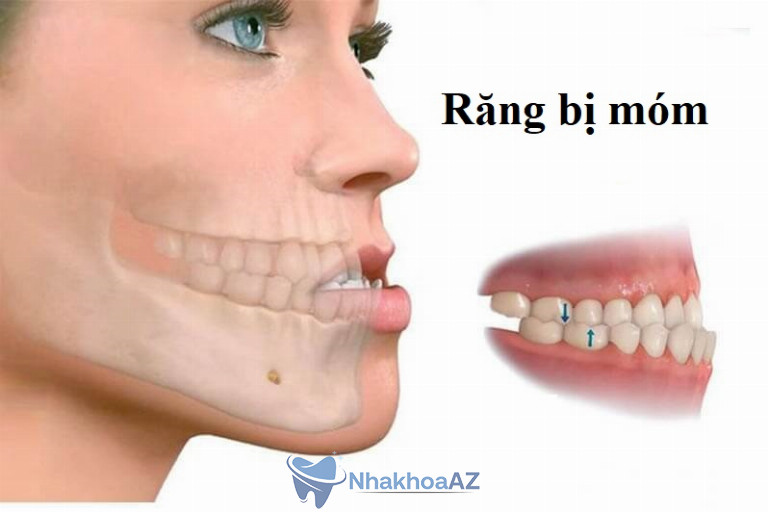 Hình ảnh một người bị móm răng