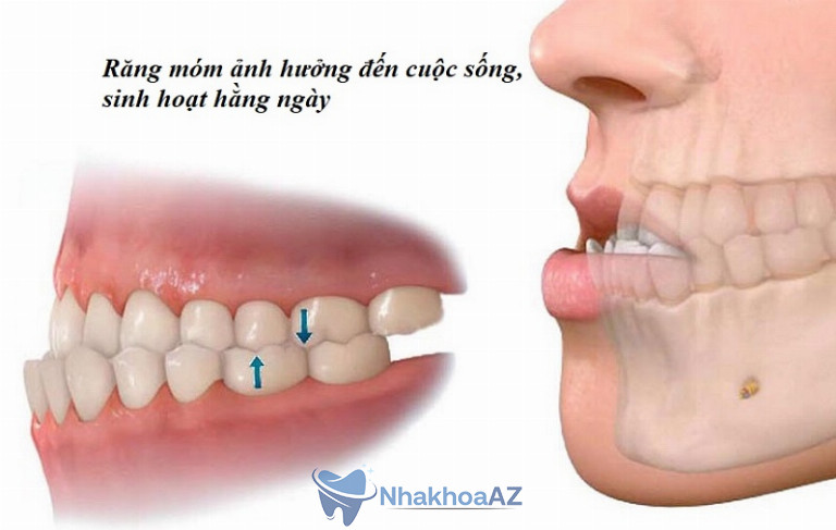 Răng móm ảnh hưởng nhiều đến hoạt động sinh hoạt hằng ngày