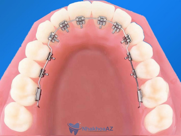 Niềng răng mặt lưỡi có tính thẩm mỹ cao