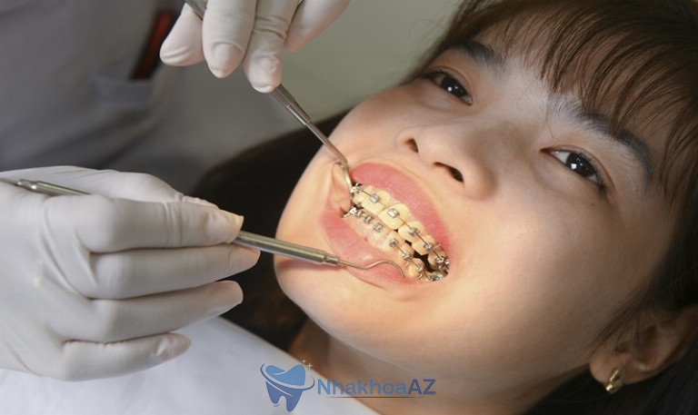 Niềng trong bao lâu còn tùy thuộc vào tình trạng của mỗi người