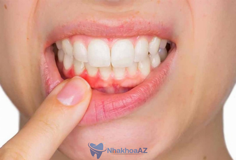 Không vệ sinh sạch sẽ rất dễ bị viêm lợi trùm