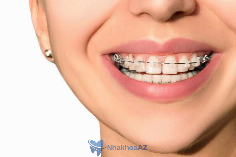 Niềng răng giúp khắc phục tình trạng răng lệch lạc rất hiệu quả