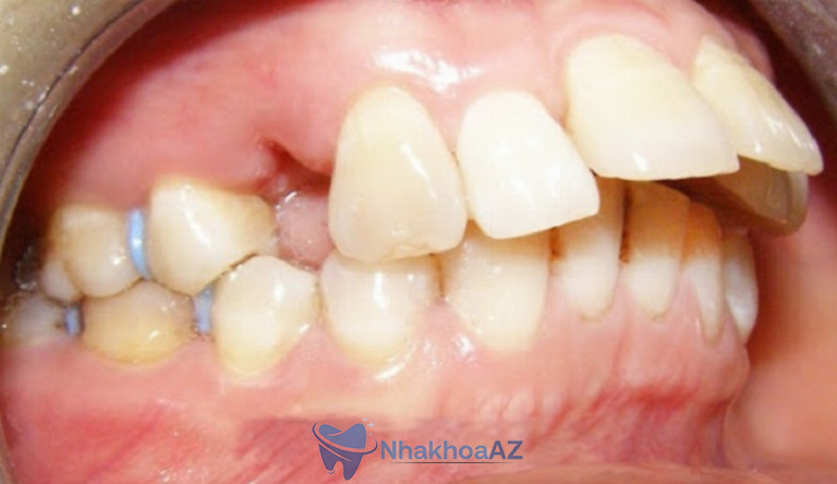 Tình trạng răng cửa bị vẩu