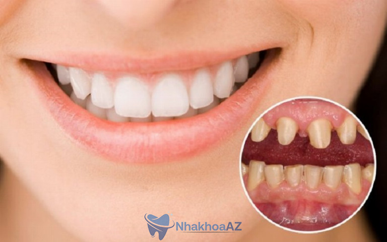 Răng ê buốt sau khi bọc sứ sẽ xảy ra trong thời gian 1 cho đến 2 tuần đầu tiên