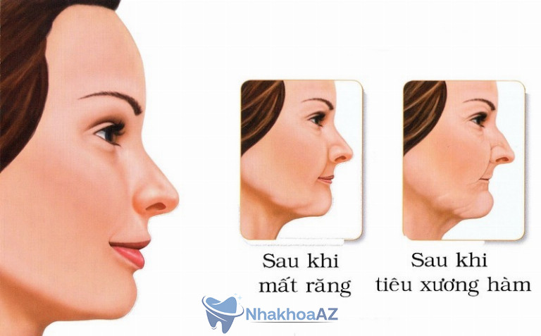 Mất răng hàm lâu sẽ gây lão hoá da, tiêu xương hàm
