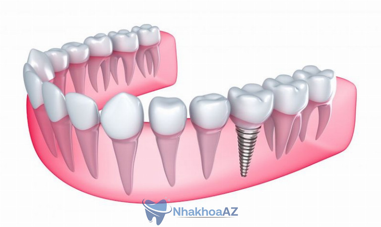 Cấy ghép Implant là phương pháp nha khoa hiện đại nhất