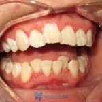 Răng khấp khểnh