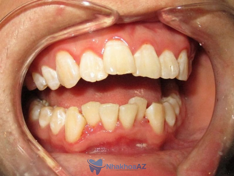 Hình ảnh răng bị khấp khểnh không đều nhau