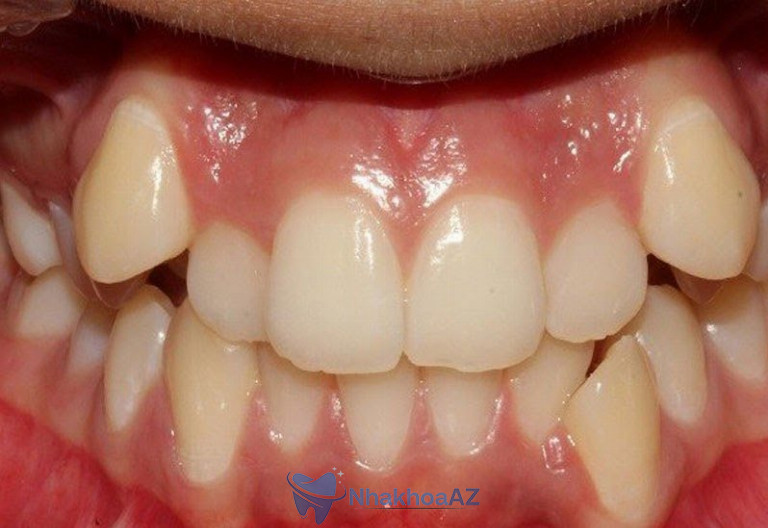 Hàm răng khấp khểnh kém thẩm mỹ khiến nhiều người tự tin khi giao tiếp