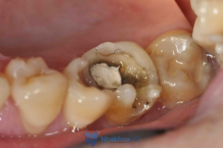 Hình ảnh răng bị sâu