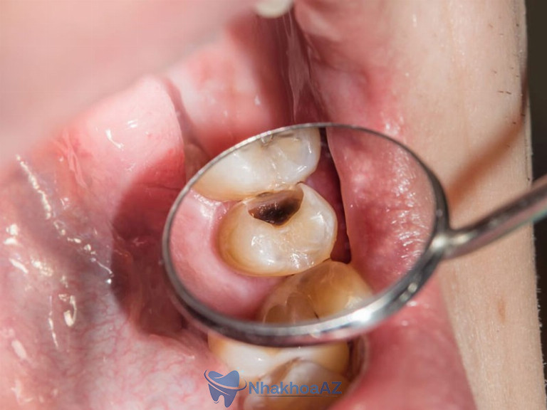Hình ảnh răng bị sâu