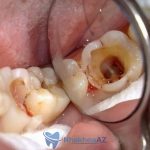 sâu răng ăn vào tuỷ