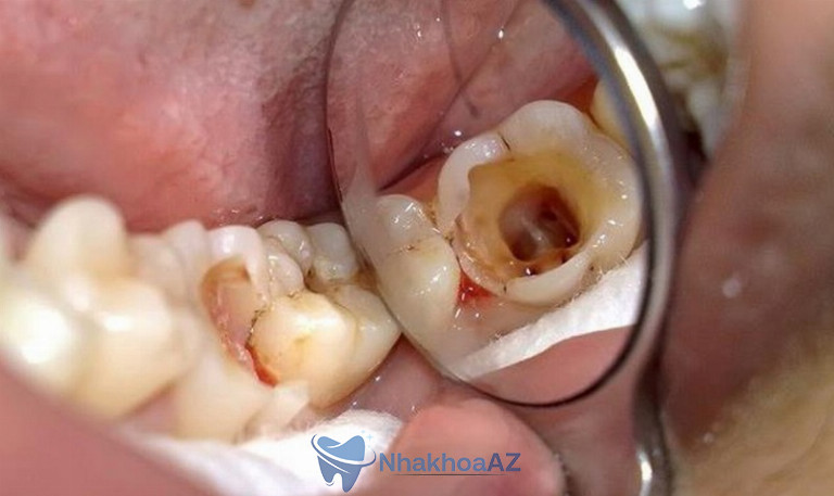 Vi khuẩn sâu răng xâm nhập, tấn công và phá hủy lớp men răng