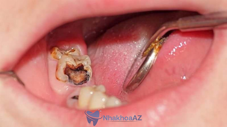 Sâu răng hàm làm tăng nguy cơ mắc bệnh tim mạch.