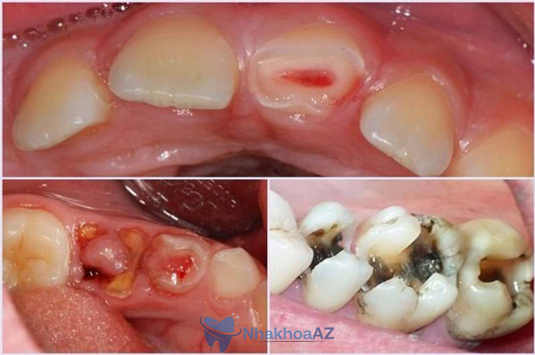 Cấp độ của sâu răng hàm