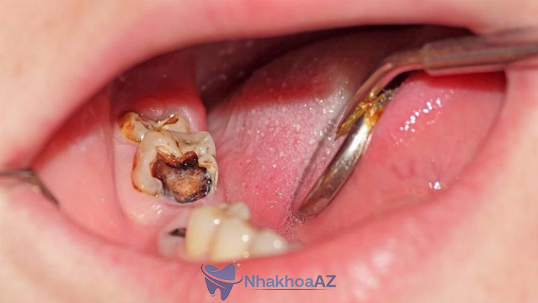 Khi răng sâu không thể phục hồi, người bệnh bắt buộc phải nhổ răng.