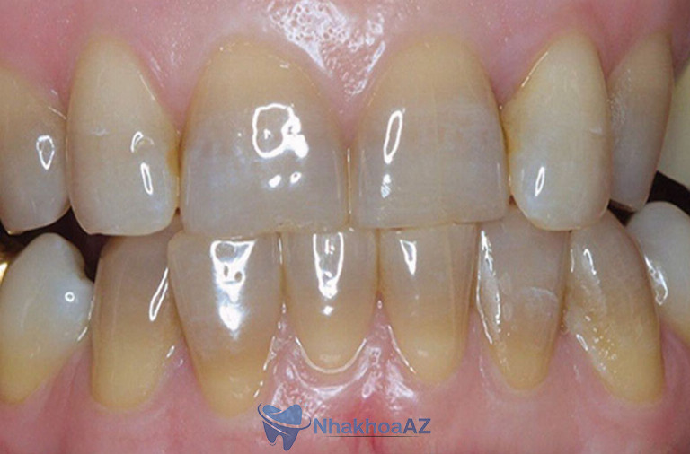 Phương pháp được áp dụng với các trường hợp răng ố vàng, nhiễm màu...