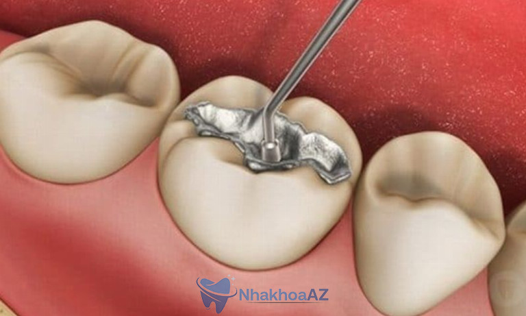 Trám răng sâu bằng chất liệu gì? Composite, amalgam được sử dụng phổ biến