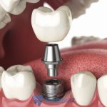 trồng răng, cấy ghép implant