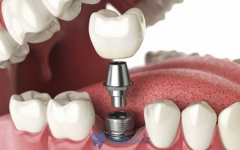 Trồng răng implant là phương pháp phục hình răng đã mất hiện đại, sở hữu nhiều ưu điểm vượt trội