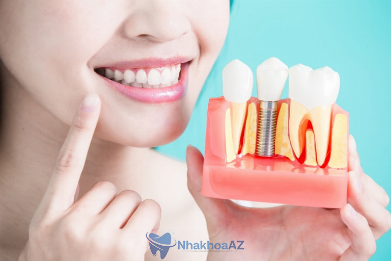 Cấy ghép implant giúp ngăn chặn được tình trạng tiêu xương hàm do mất răng