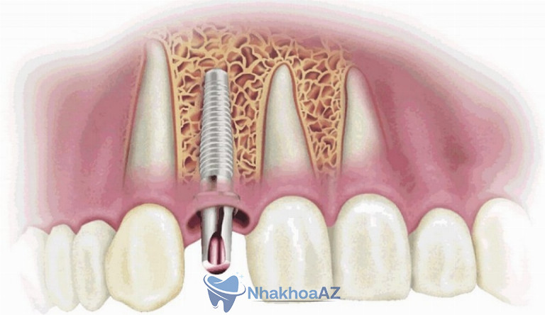 Đặt implant vào xương hàm được đánh giá là bước làm quan trọng nhất