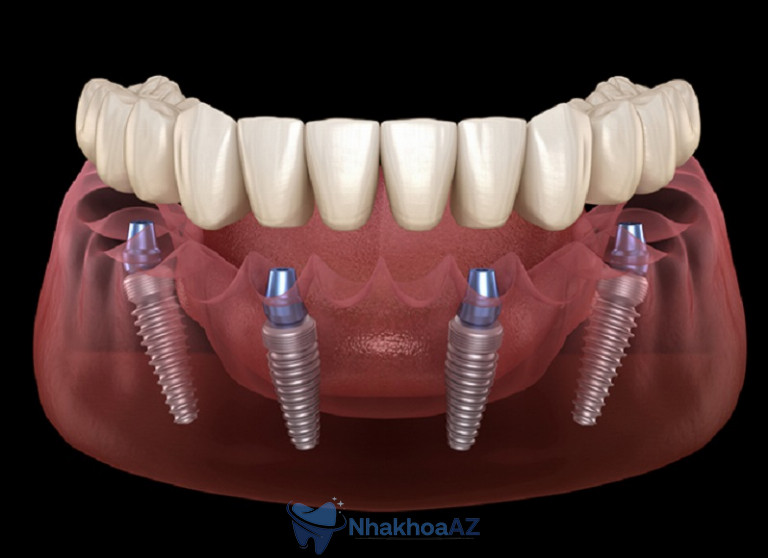 Cấy ghép implant mất nhiều thời gian không phụ thuộc vào nhiều yếu tố