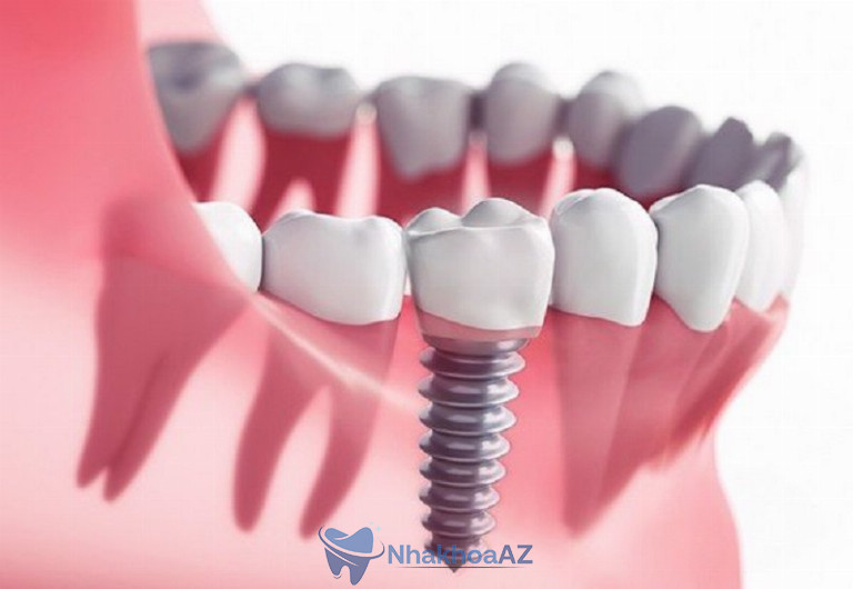 Chi phí cấy ghép implant phụ thuộc nhiều vào chất liệu trụ răng