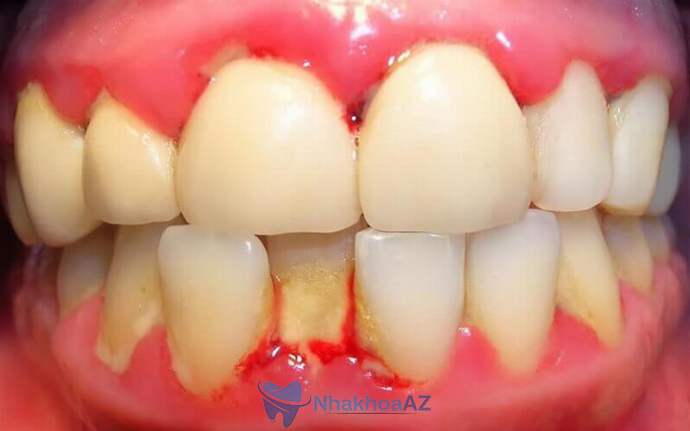 Viêm nha chu là tình trạng viêm nhiễm tổ chức xung quanh răng