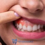 Viêm nướu răng nên ăn gì để giảm bớt sự khó chịu